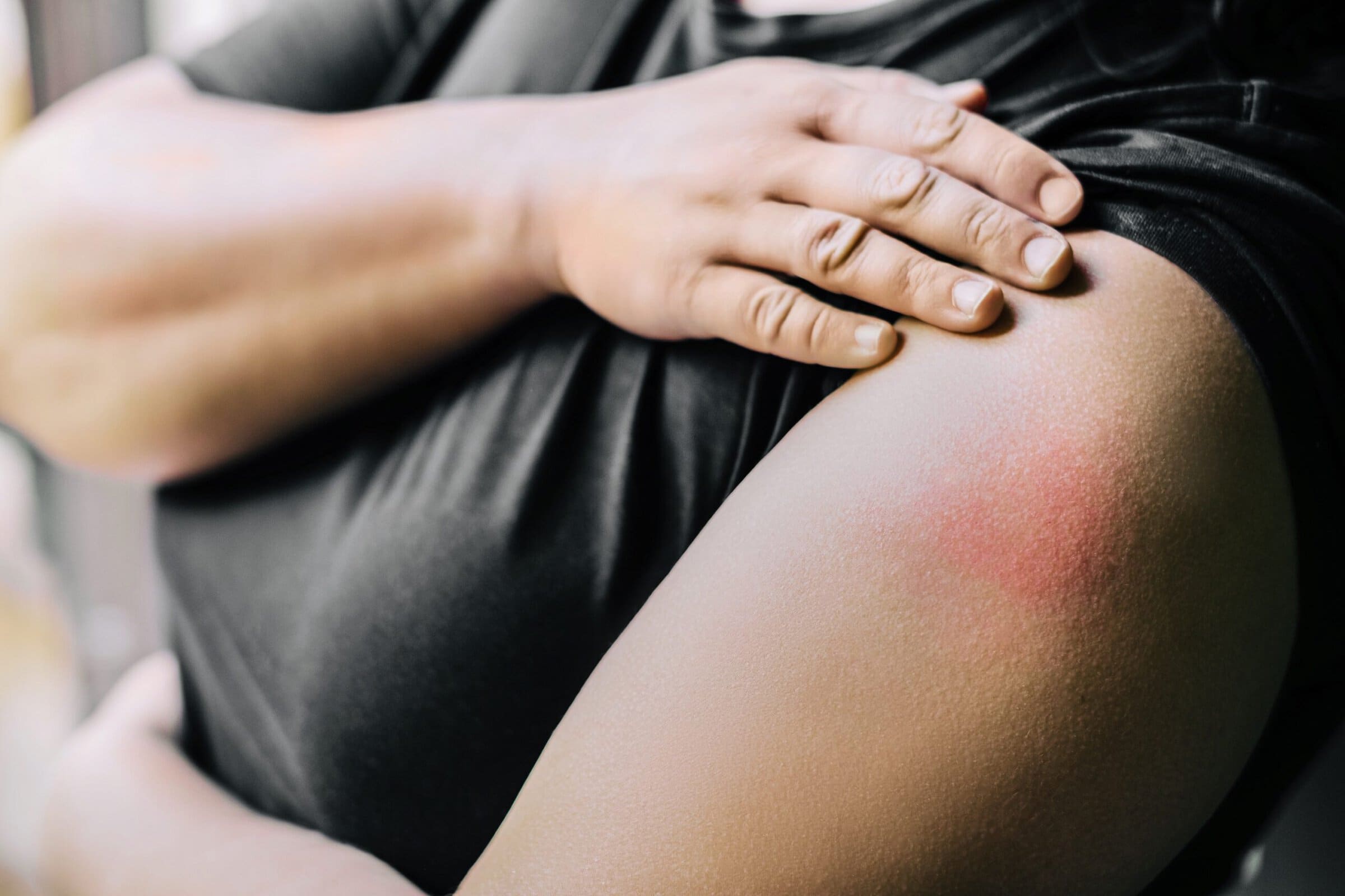 Swollen,Red,After,Vaccine,Reaction,At,The,Injection,Site.,Arm